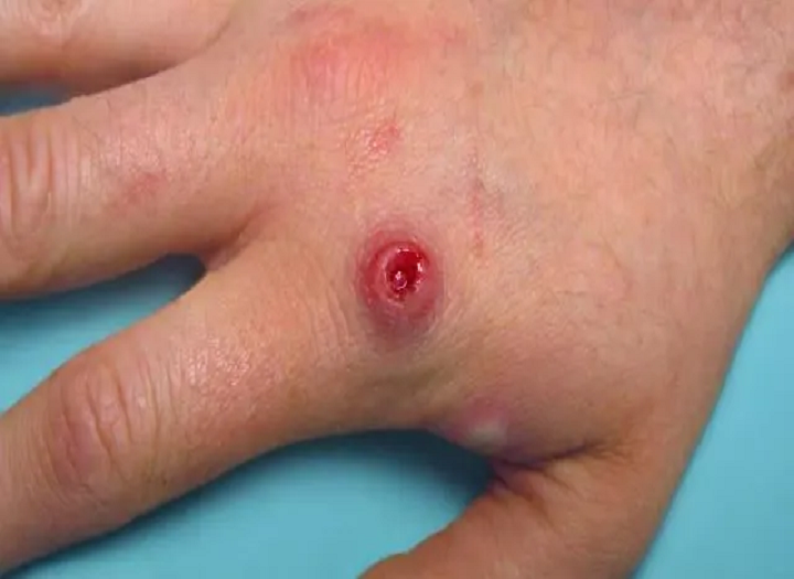 Κατανόηση του monkeypox και πώς να το αποτρέψετε？